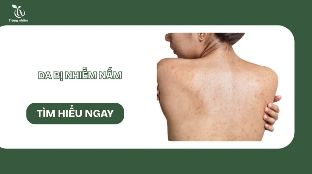Da bị nhiễm nấm