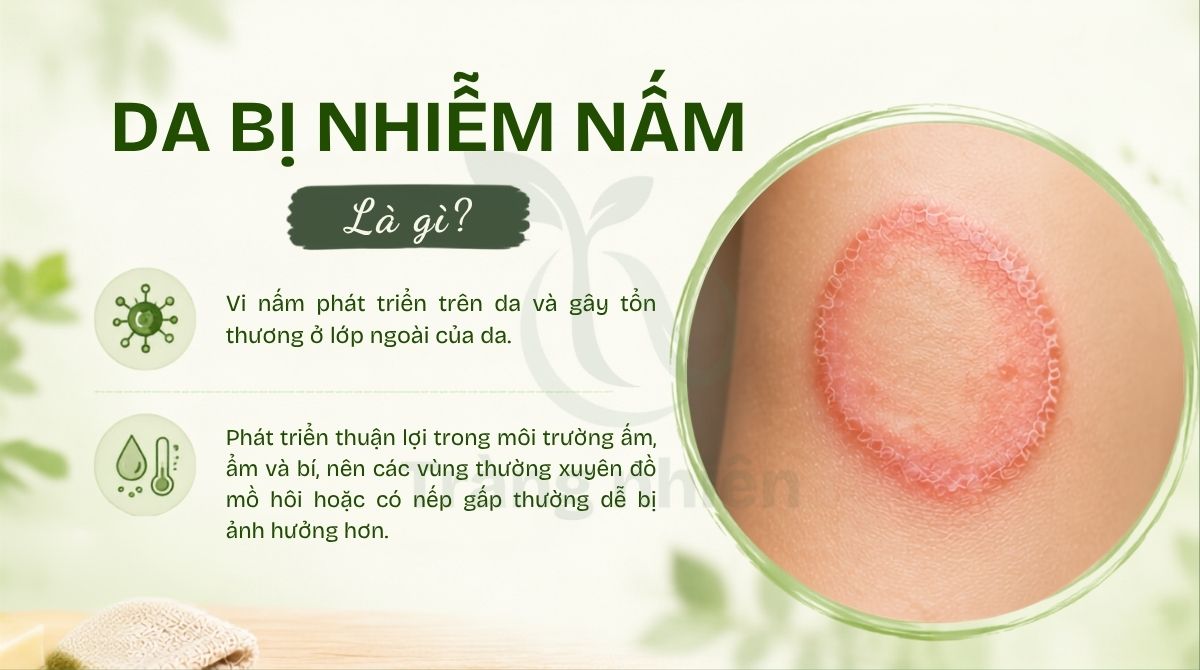 Da bị nhiễm nấm là gì