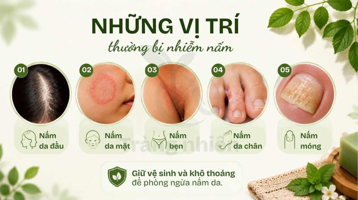 Vị trí thường bị nấm da